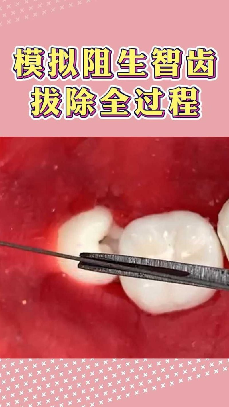 智齿拔除